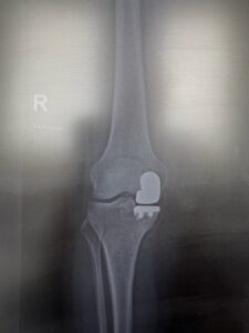 Po wykonaniu alloplastyki połowiczej