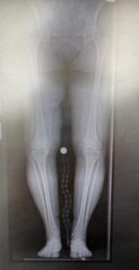 Przed wykonaniem alloplastyki połowiczej